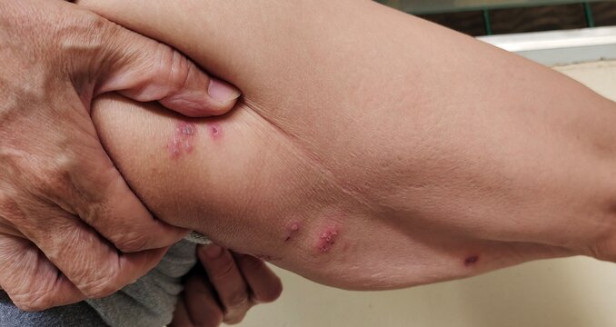 portrait showing the herpes and blistering, inflammation skin and scar, scratch and sadness, health care and medical concept.