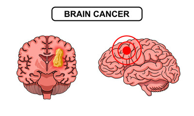 Brain tumor illustration. Human brain cancer, glioma, tumor in human brain tissue. Cancer cell structure. Vector illustration for medical, scientific, and educational purposes.