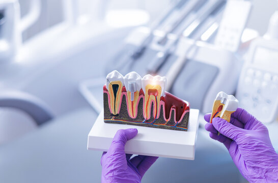 Dental model displaying tooth anatomy with caries and pulpitis cyst held by gloved hands in dental office - Powered by Adobe