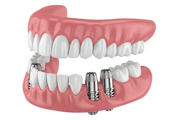 Realistic dental implants and dentures on a transparent background isolated on transparent background