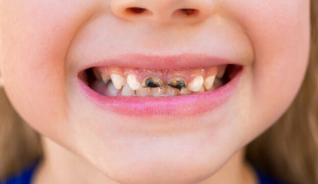 Children's teeth with caries. Close-up of teeth with disease and decay from caries. Diseased human teeth.