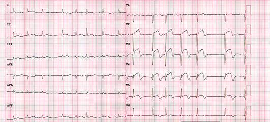 Naklejka premium Acute Anterior Myocardial Infarction ECG with Ventricular Tachycardia Complication STEMI Medical Emergency Cardiology Diagnostic