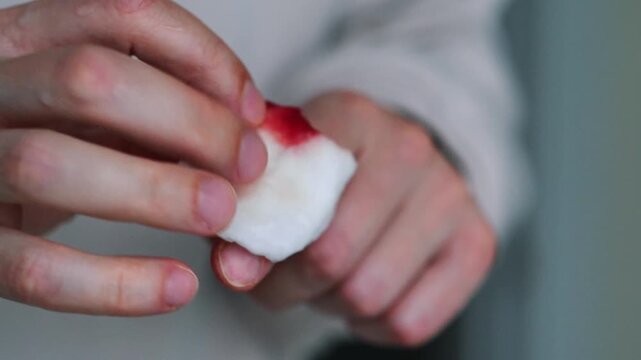 A person stops bleeding on a finger with a cotton swab and disinfects the wound.
Blood on a finger after a knife cut.
Disinfection and treatment of a wound on a hand.
Wound6 body, medicine, blood, fin