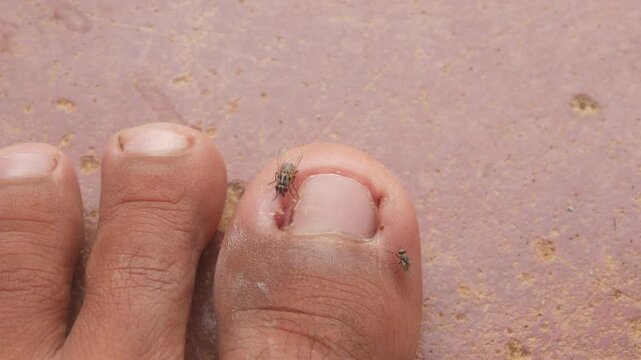 Flies gathered on a man's big toe due to an ingrown toenail