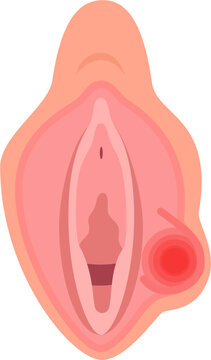 Bartholins Cyst 