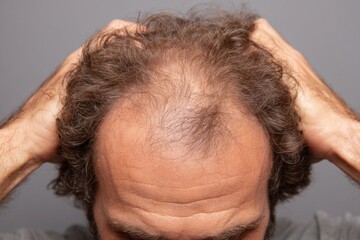 Fototapeta premium Male Hair Loss and Baldness – Scalp Thinning Problem Close Up
