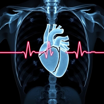 Atrial fibrillation minimally invasive procedure attack Cardiac catheter ablation rhythm problem cath lab treat treatment Coronary x-ray Radio frequency Sinus Ventricular SVT ECG ICD Radiofrequency AV
