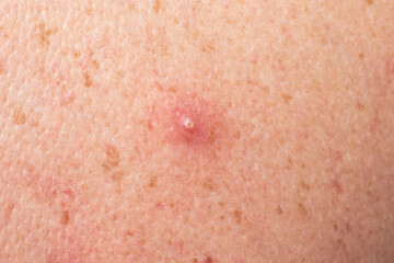 Fototapeta premium Close-up macro shot of irritated human skin with a small inflamed bump. Detailed texture, pores, and pigmentation visible. Useful for dermatology illustrations, skincare materials, educational content