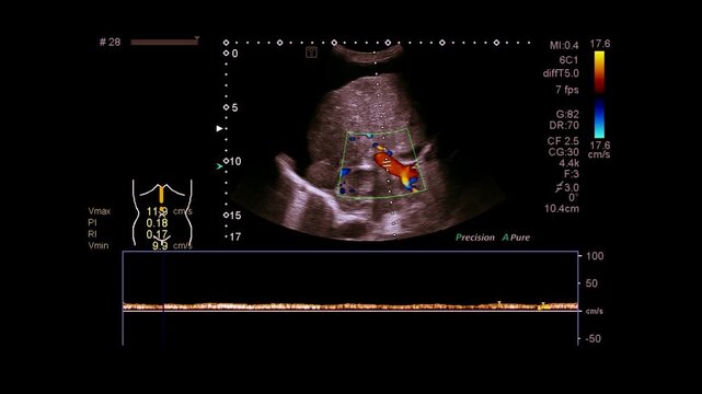 ultrasonography of portal vein in cirrhotic patient