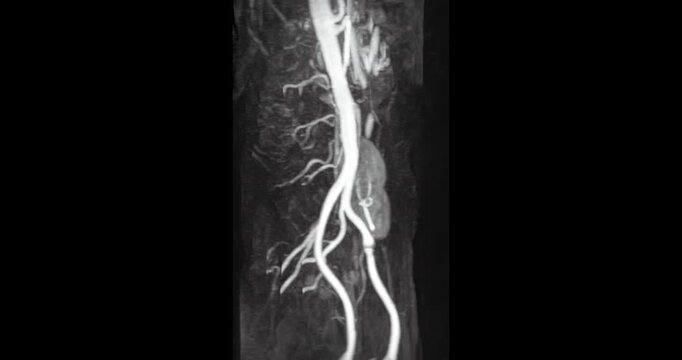 MRA (Magnetic Resonance Angiography) of Renal Artery Footage: Medical imaging showing a transplanted kidney on the left side with vascular structures.
