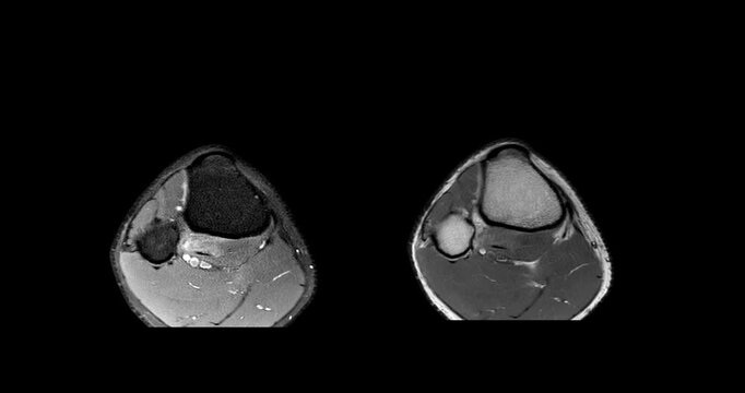 High-Resolution MRI Scan of the Human Knee Joint T2 FS and T2 with Joint Effusion (axia View), showing fluid accumulation and related internal structures for orthopedic diagnosis.