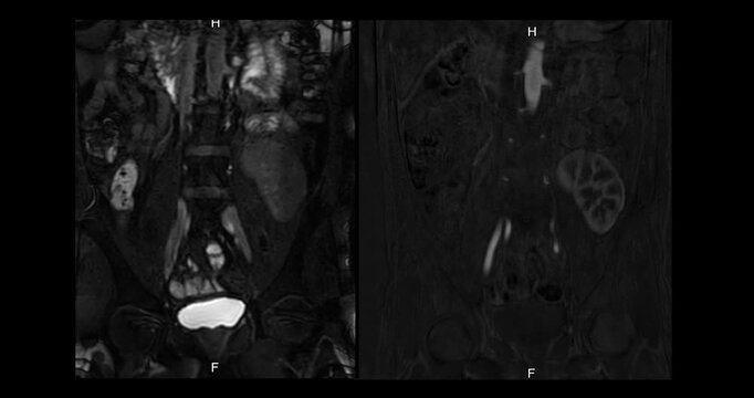 MRA (Magnetic Resonance Angiography) of Renal Artery Footage: Medical imaging showing a transplanted kidney on the left side with vascular structures.