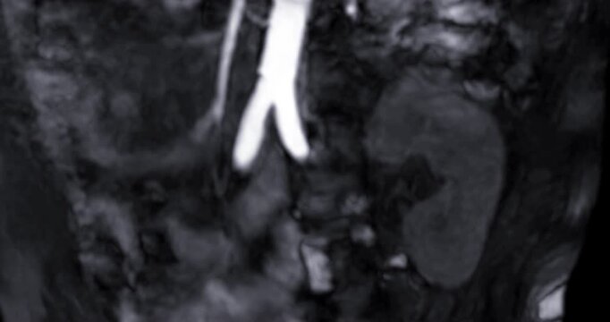 MRA (Magnetic Resonance Angiography) of Renal Artery Footage: Medical imaging showing a transplanted kidney on the left side with vascular structures.