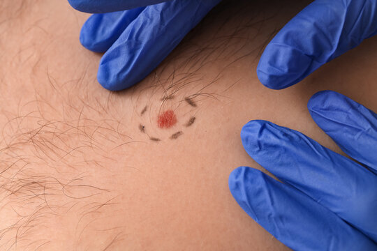 Dermatologist examining marked mole on young man's chest, closeup