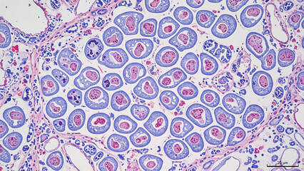Microscopic view of nasopharyngeal cancer cells with distinct cellular structures and colors 30208839 1