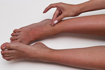 Woman's hands gently removing flaky skin from sunburned legs, showcasing detailed dermatological care and healing after excessive UV exposure.