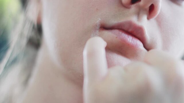 Close-up of a young woman applying cold sore ointment to her lips. Redness and virus on lips