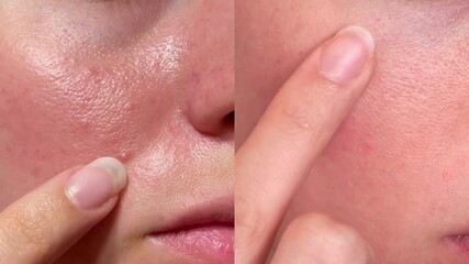 Macro close-up of real facial skin texture, pores and redness with finger touch. Ideal for skincare, dermatology, cosmetic products, before-after comparison and beauty industry visuals.