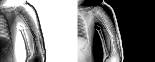 Arm Anterior View X-Ray Radiograph Showing Detailed Bone Alignment and Muscle Structure for Surgical Planning, Fracture Diagnosis Isolated on Transparent Background