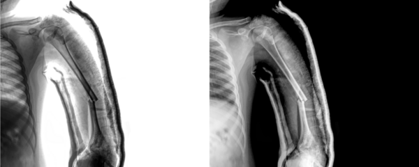 Arm Anterior View X-Ray Radiograph Showing Detailed Bone Alignment and Muscle Structure for Surgical Planning, Fracture Diagnosis Isolated on Transparent Background