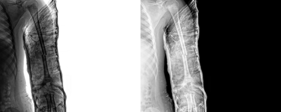 Arm Anterior Projection X-Ray Image Bone Anatomy, and Structural Details for Surgical Planning and Accurate Fracture Assessment, Isolated on Transparent Background