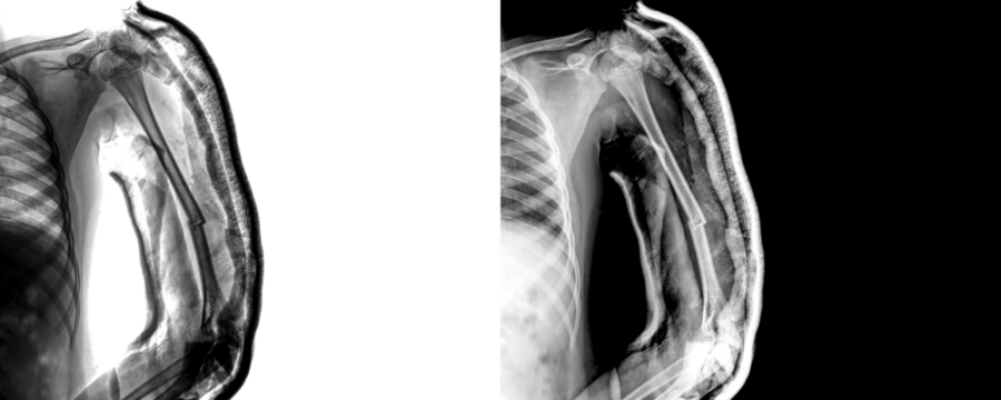 Arm Lateral View X-Ray Radiograph Showing Detailed Bone Alignment and Surgical Planning, Fracture Diagnosis, and Clinical Evaluation Isolated on Transparent Background