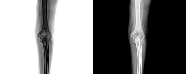 Elbow Anterior View X-Ray Radiograph Showing Detailed Bone Structure for Diagnosis of Elbow Joint Fractures and Traumatic Injuries Isolated on Transparent Background