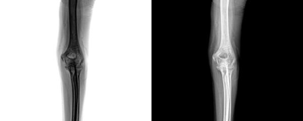 Elbow Anterior View X-Ray Radiograph Showing Detailed Bone Structure for Diagnosis of Elbow Joint Fractures and Traumatic Injuries Isolated on Transparent Background