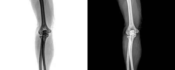 Elbow Anterior Projection X-Ray Image Displaying Joint Alignment and Bone Anatomy for Accurate Identification of Fractures Isolated on Transparent Background