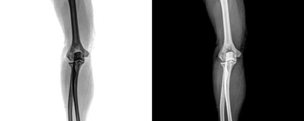 Elbow Anterior Projection X-Ray Image Displaying Joint Alignment and Bone Anatomy for Accurate Identification of Fractures Isolated on Transparent Background