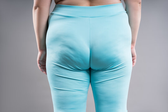 Buttocks and hip liposuction, fat and cellulite removal concept, overweight female body