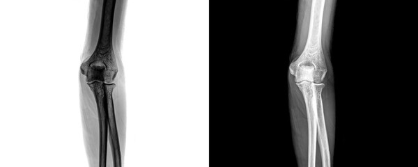 Medical Elbow Anterior View X-Ray Radiograph Illustrating Bone Integrity and Joint Condition for Detection of Fractures and Trauma Isolated on Transparent Background