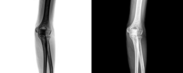 Medical Elbow Anterior View X-Ray Radiograph Illustrating Bone Integrity and Joint Condition for Detection of Fractures and Trauma Isolated on Transparent Background