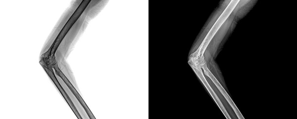 Elbow Lateral Projection X-Ray Image Displaying Bone Integrity and Joint Orientation for Precise...