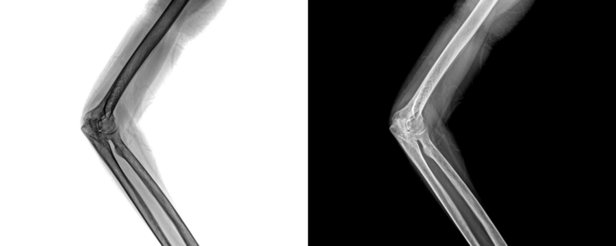 Elbow Lateral Projection X-Ray Image Displaying Bone Integrity and Joint Orientation for Precise Identification of Fractures Isolated on Transparent Background - Powered by Adobe