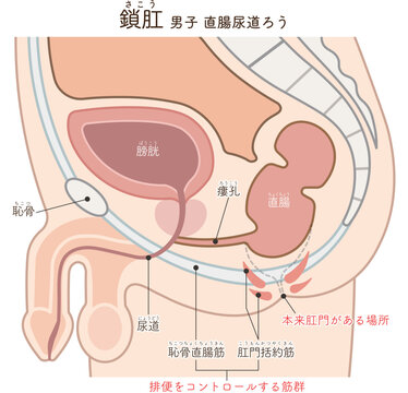 男性の鎖肛　直腸尿道ろう　imperforate anus(ARM) illustration