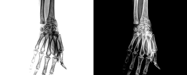 Wrist Anterior Projection X-Ray Image Displaying Detailed Bone and Joint Anatomy for Detection of Fractures, Arthritis, Isolated on Transparent Background