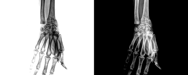 Wrist Anterior Projection X-Ray Image Displaying Detailed Bone and Joint Anatomy for Detection of Fractures, Arthritis, Isolated on Transparent Background