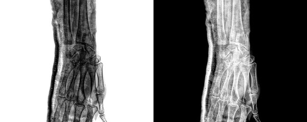 Wrist Joint Anterior View X-Ray Radiograph Depicting Bone Integrity and Features, and Structural Disorders Isolated on Transparent Background