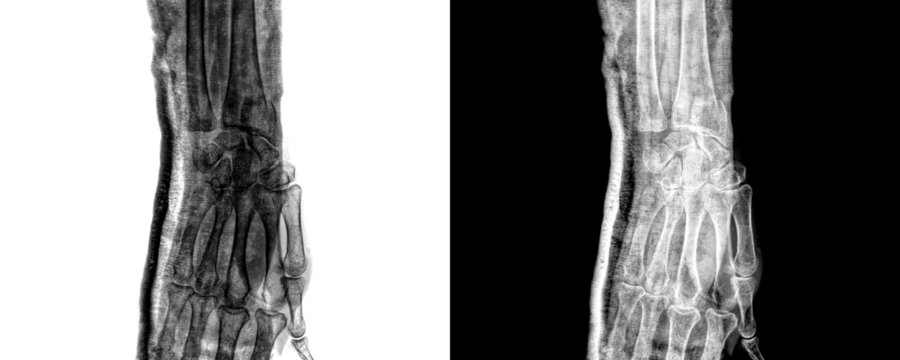 Wrist Joint Anterior View X-Ray Radiograph Depicting Bone Integrity and Features, and Structural Disorders Isolated on Transparent Background