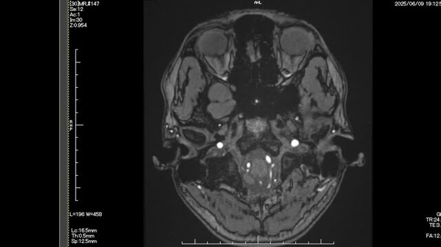 An axial MRI scan of a human head, centered in the frame from top view.
