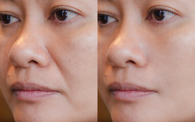 Before and after comparison of an Asian woman receiving dermal filler treatment for marionette...