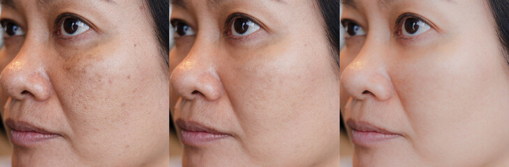 cropped Image before and after spot melasma pigmentation treatment on skin face asian woman compare in 3 development periods. Skincare and beauty concept	