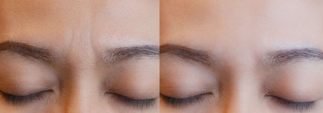 Photos before and after mesotherapy, biorevitalization, botulinum toxin injections. Skin fold between eyebrows, forehead wrinkles. At the appointment with a plastic surgeon or cosmetologist
