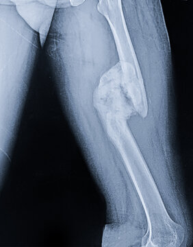 Chronic Femur Fracture with Extensive Callus and Calcified Soft Tissue on X-ray