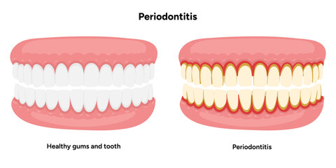 Hand-drawn dental illustration showing comparison between healthy teeth and teeth affected by periodontal problems. Includes gum inflammation, plaque buildup, and root exposure