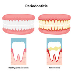 Hand-drawn dental illustration showing comparison between healthy teeth and teeth affected by periodontal problems. Includes gum inflammation, plaque buildup, and root exposure and tooth anatomy