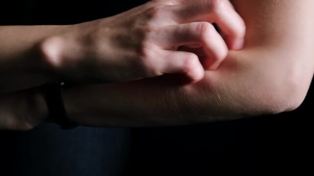 Person scratching arm showing skin irritation and discomfort with hand holding arm in pain and itching skin allergy. Allergic reaction. High quality 4k footage.