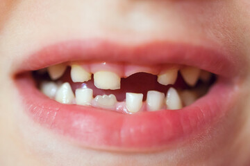 Close up child caries