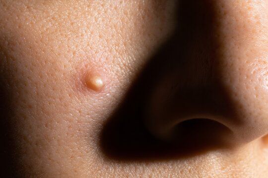 Close up of a small raised bump on human skin near the nose